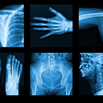 X- Ray