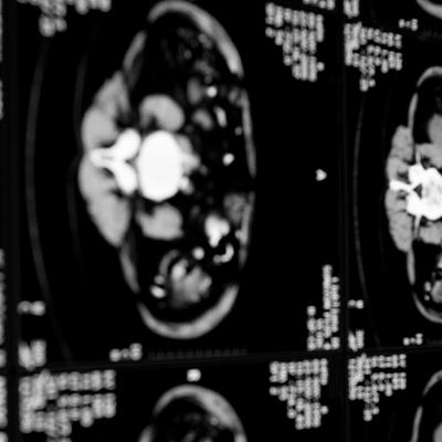 Ct Scan