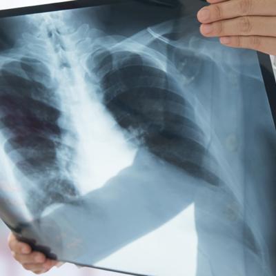 X- Ray