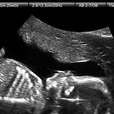 Ultrasound